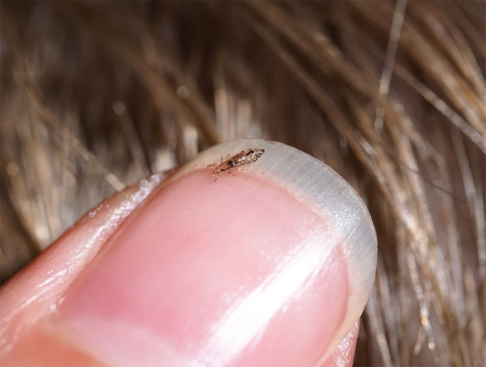 از بین بردن شپشک مو